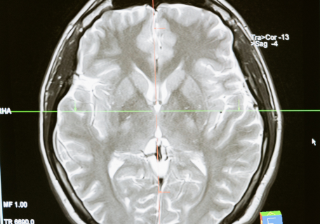 MRI scan of the human brain highlighting neurological structures.